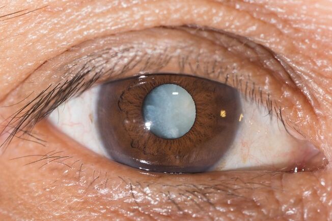Con cataratas, están indicados exercicios para mellorar a visión.